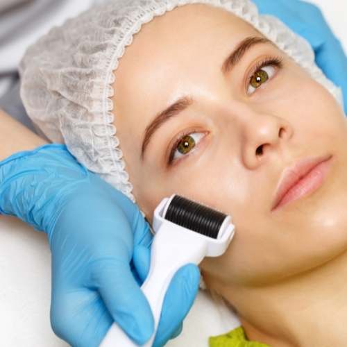 Microneedling dermaroller treatment on a ladies face